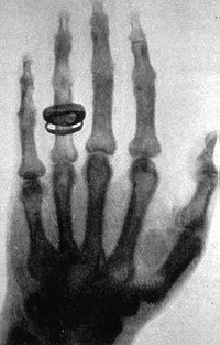 primeiraradiografia_Wilhelm_Röntgen_of_Albert_von_Köllikers_hand