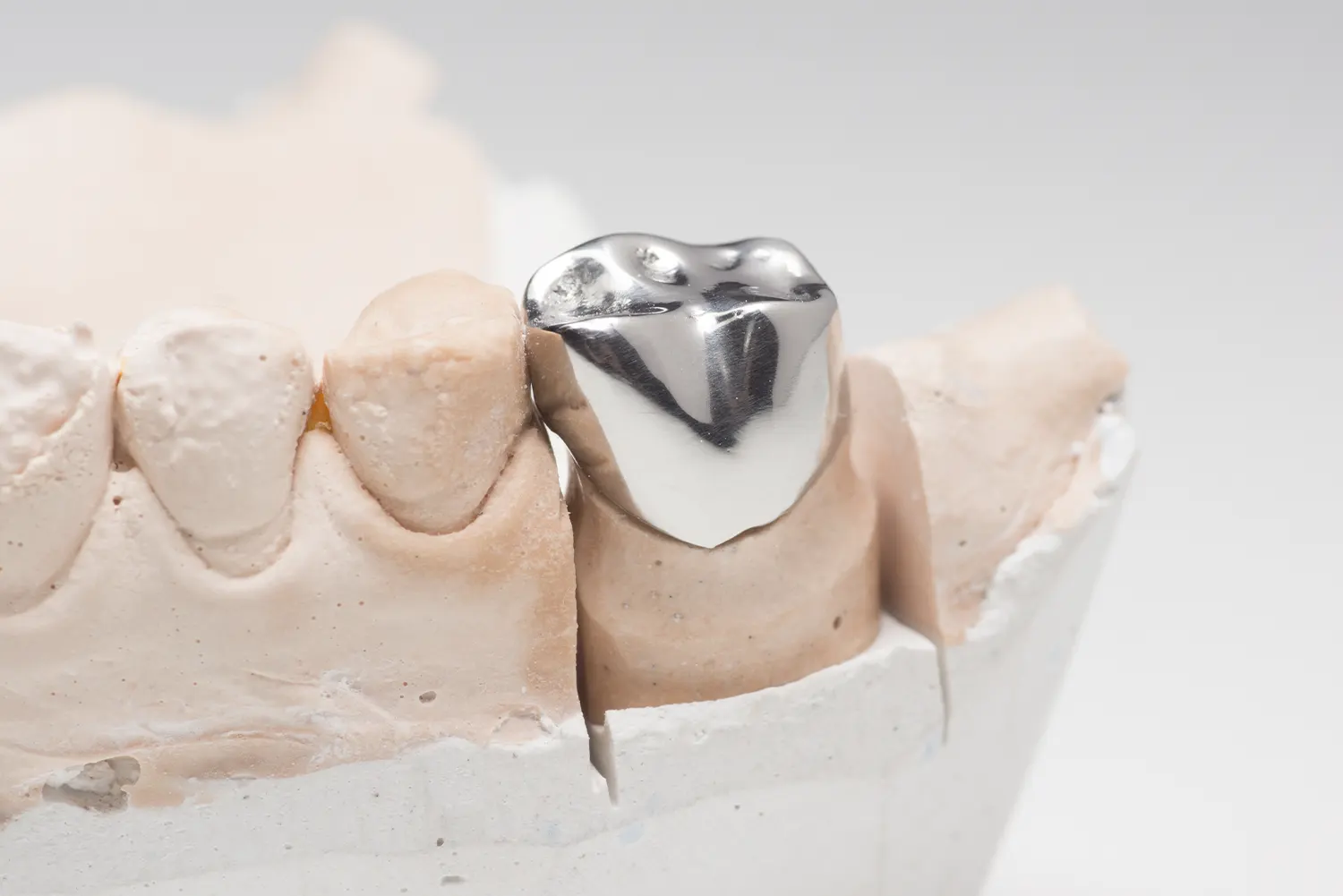 Stainless Steel vs. White Crowns: What’s Best for Your Child’s Smile?