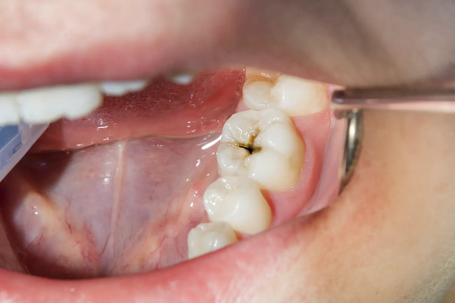 Why It’s Important to Fill Cavities in Baby Teeth