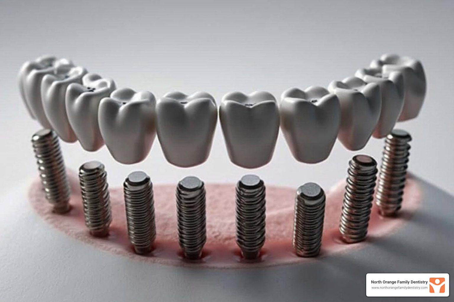 The Price of a Perfect Smile: Full Mouth Dental Implant Costs