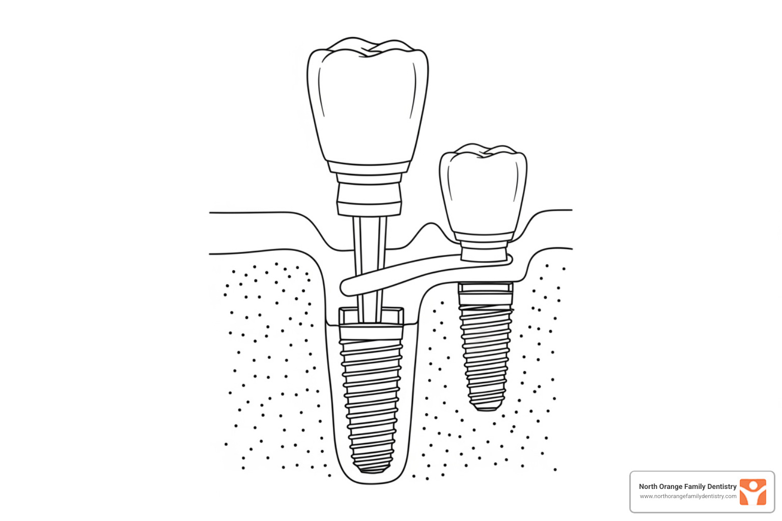 diagram showing the three components of a dental implant - how much does it cost to get dental implants