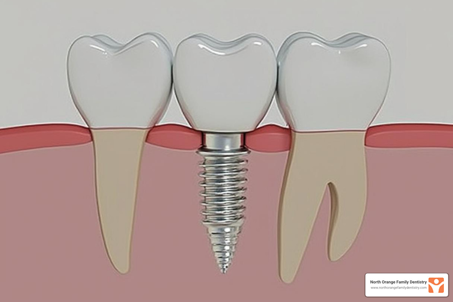 of a single dental implant model - dental implants cost