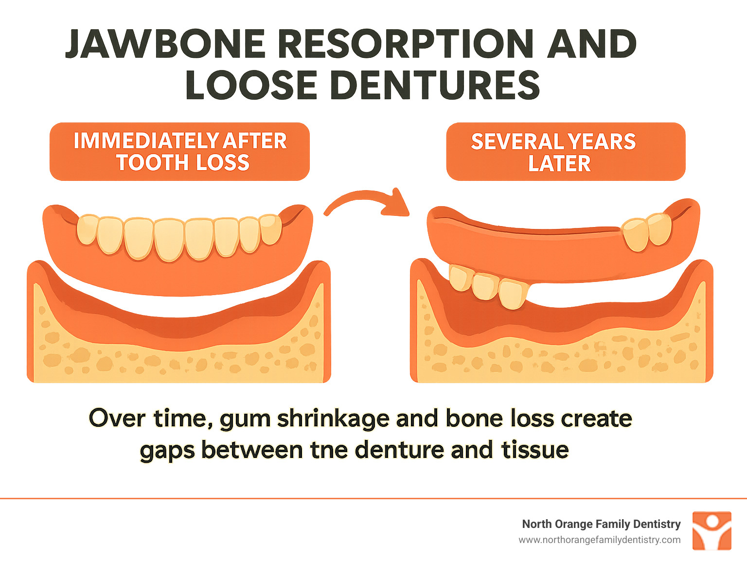 Infographic showing how jawbone resorption over time causes dentures to become loose, with cross-sectional views of the mouth immediately after tooth loss versus several years later, demonstrating gum shrinkage and bone changes that create gaps between the denture and tissue - Denture relining cost infographic 