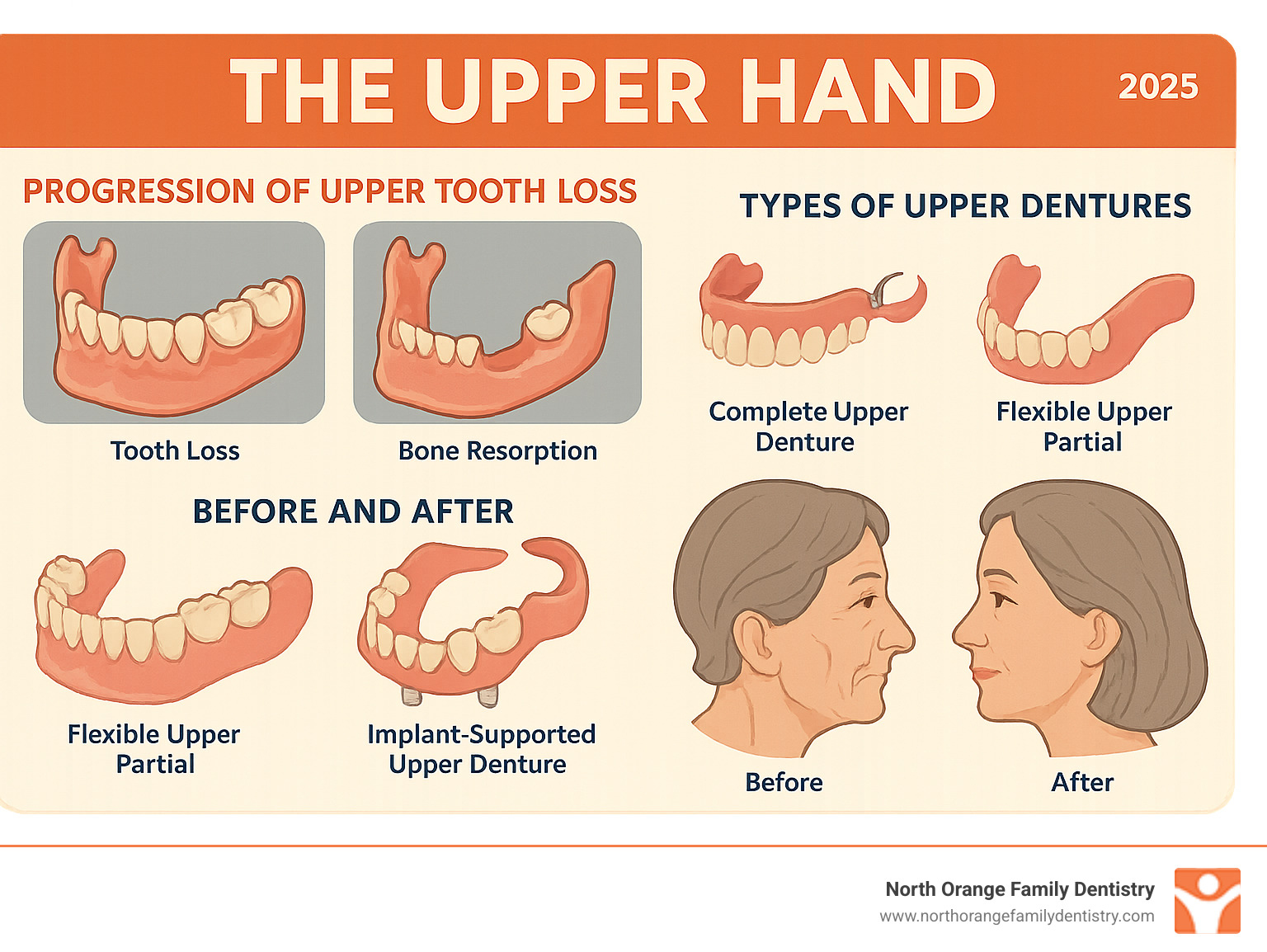 Comprehensive infographic showing the progression from upper tooth loss to bone resorption and facial changes, alongside the restorative benefits of different upper denture types including complete dentures, partial dentures, flexible partials, and implant-supported options with before and after facial profiles - upper denture infographic 