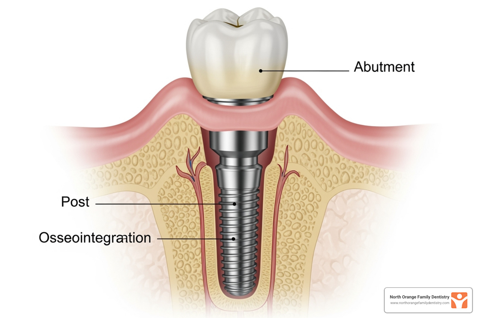 diagram showing a dental implant integrated into the jawbone - private dental implants near me