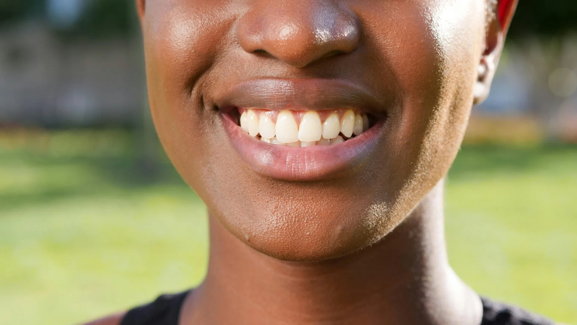 A close-up showing natural-looking bonded front teeth