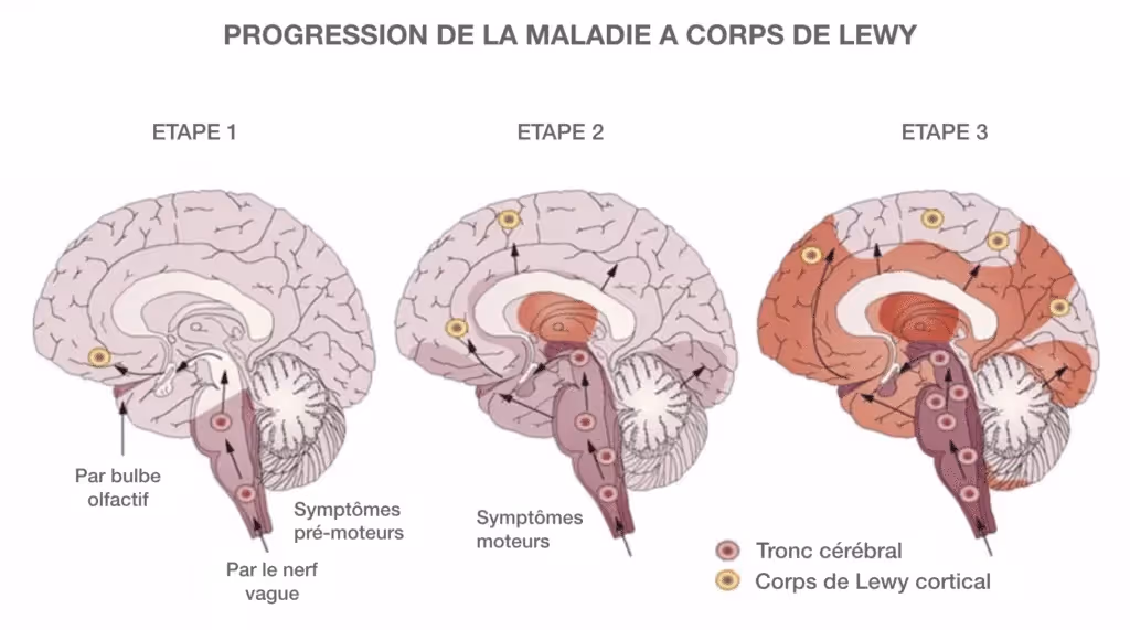 Maladie_A_Corps_de_Lewy-Explications