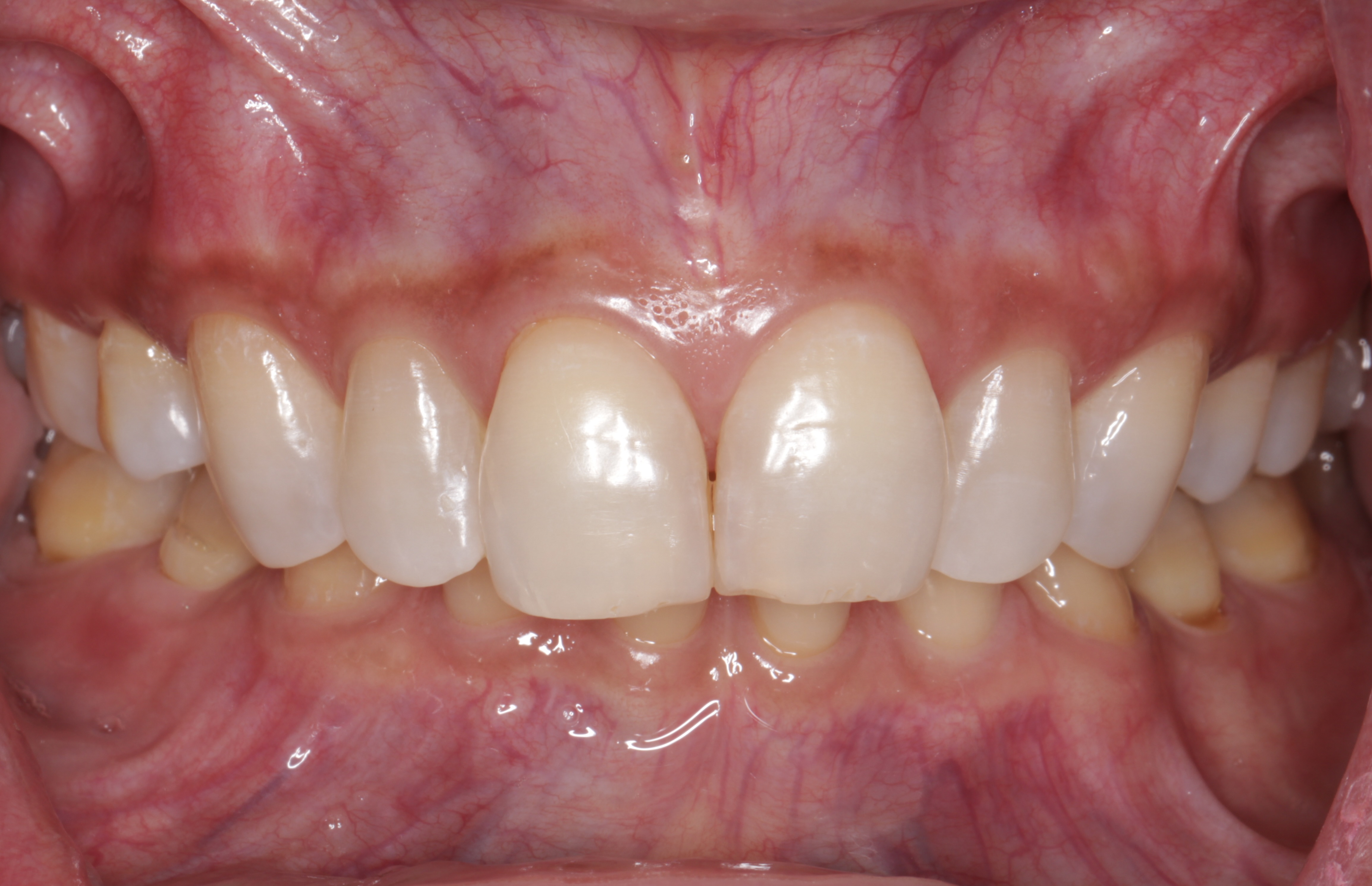 Frontal clinical photograph showing a deep bite with upper front teeth overlapping most of the lower front teeth.