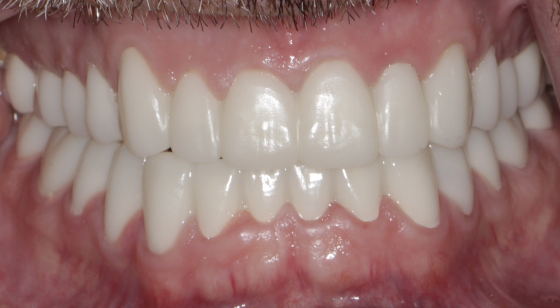 Frontal intraoral view of upper and lower prototype restorations during full-mouth reconstruction.