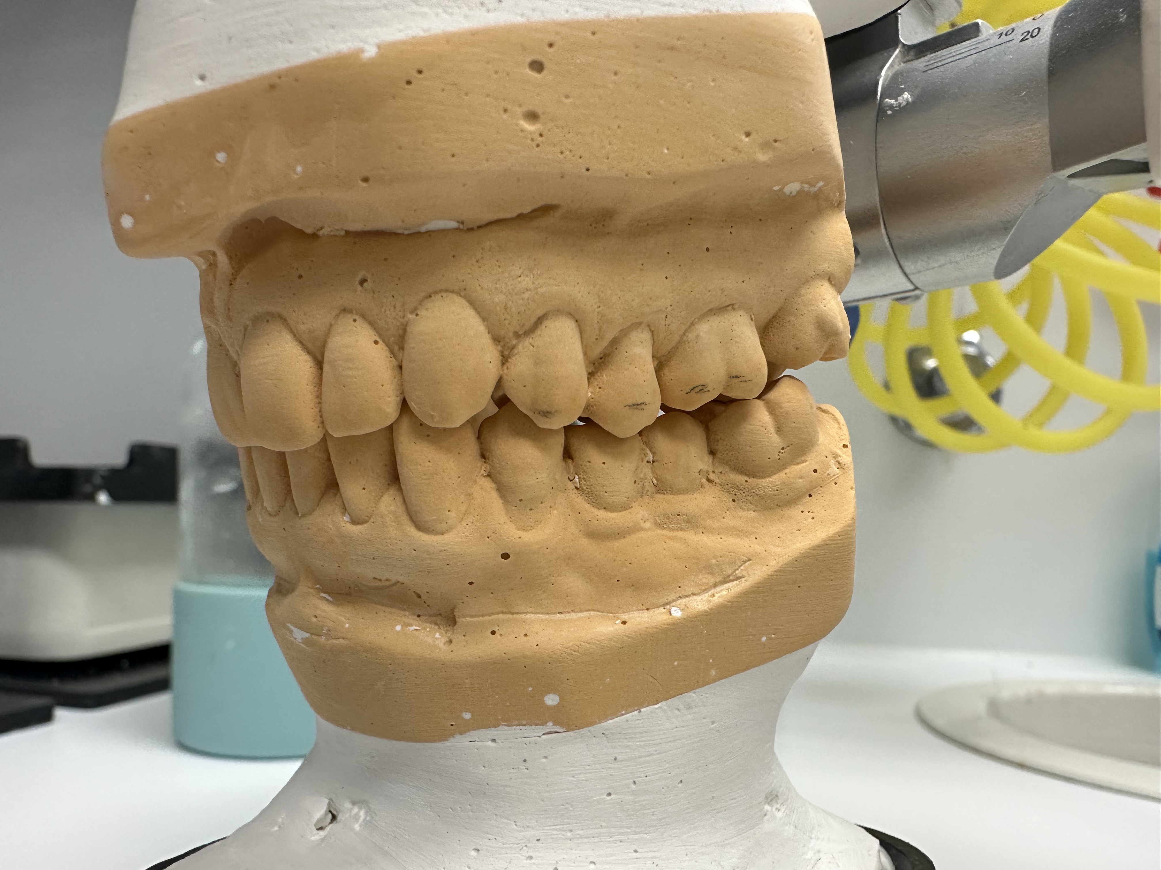 Dental casts mounted in centric relation to evaluate the relationship between jaw position and dental occlusion.