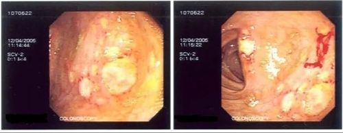 Photo of colonoscopy showing GI lesions