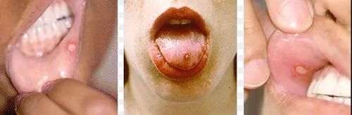 Oral lesions on inside of lip and on tongue