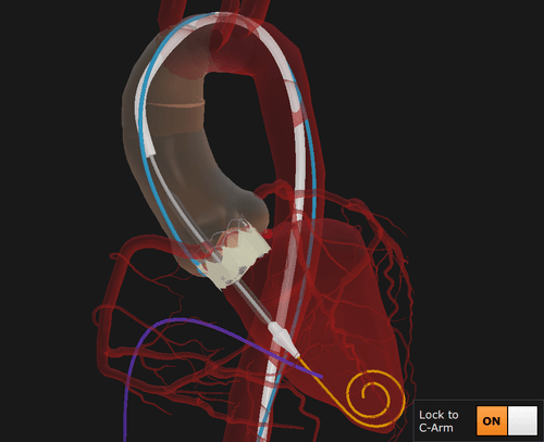 Placed balloon inflated TAVI valve