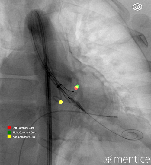 Early deployment in Cusp overlap view with help-markers
