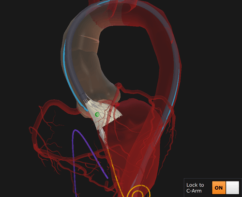 Left cusp isolation mid TAVI deployment