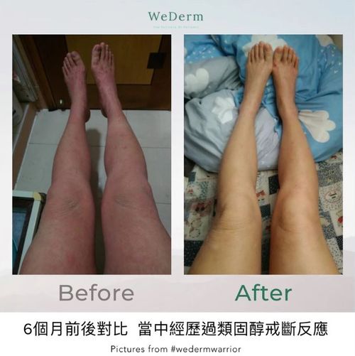 Eczema Warrior Esther: Six-Months Journey Overcoming TSW