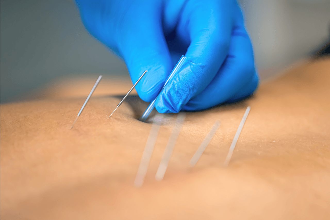 Суха голка (Dry Needling): як працює метод, ефективність та безпечність