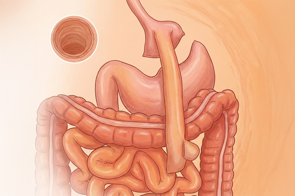 TORe procedure illustration
