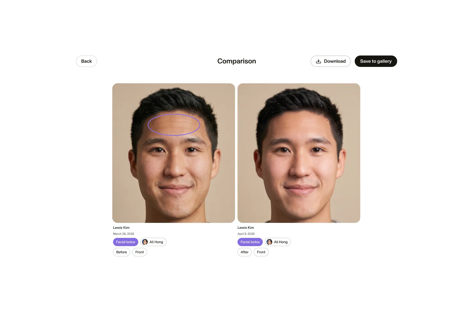 Side by side comparisons of med spa client Lewis Kim’s before and after photos targeting forehead lines