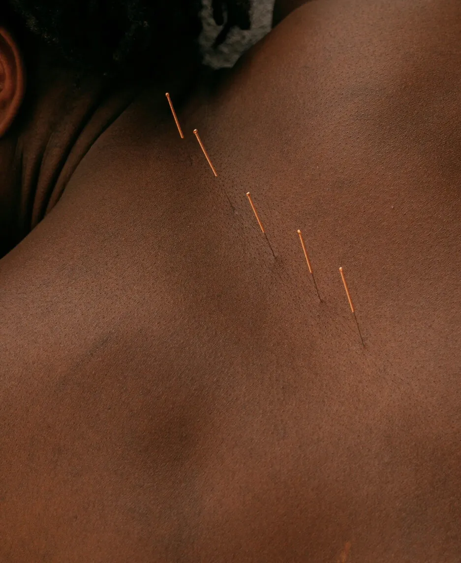 Close-up of an acupuncturist gently inserting fine needles into a patient's back during a treatment.