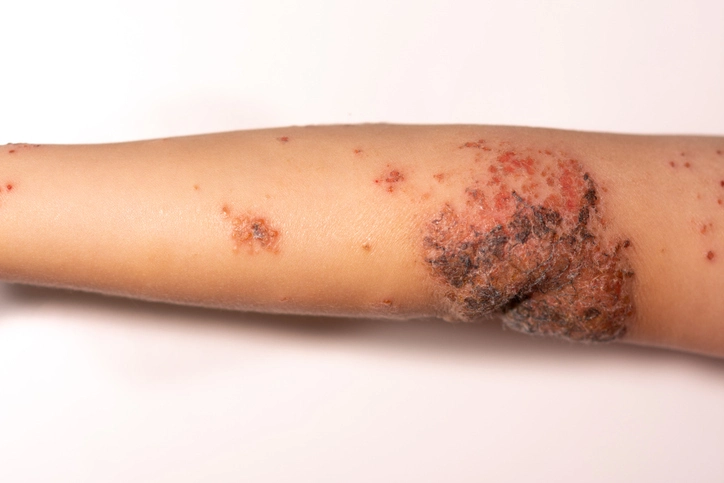 Child with non-bullous impetigo on the arm