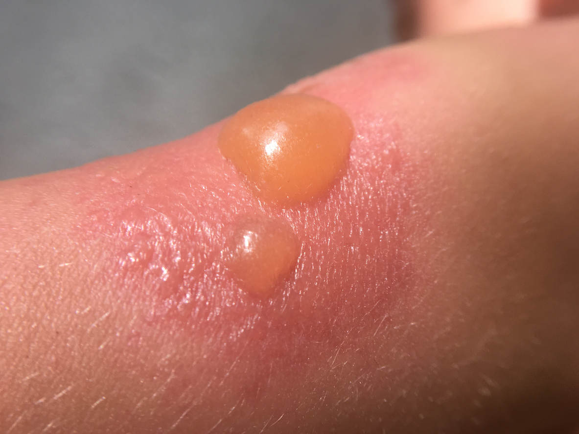 Closeup of a person's arm with a red rash and two blisters.