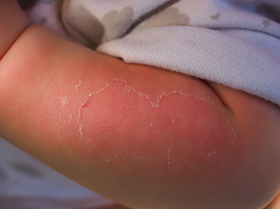 Peeling, red skin on a baby's outer arm.