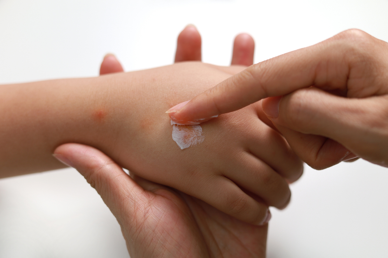 A parent applying ointment to a child's bug bite on their hand