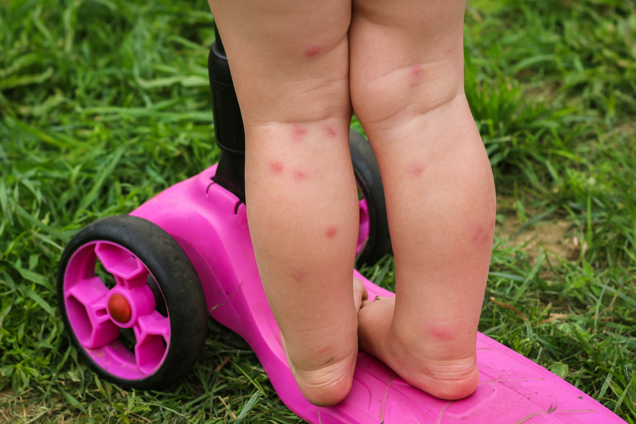Child's legs covered in bug bites standing on a a pink scooter in a field of grass