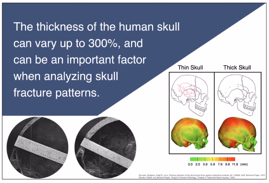 Disparate Patterns of Skull Fracture 
