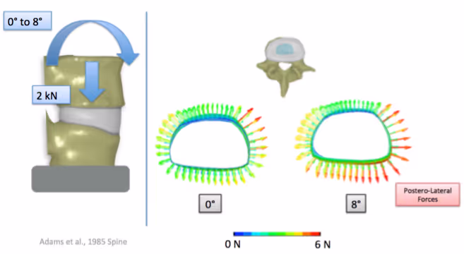 Disc Herniation Mechanism
