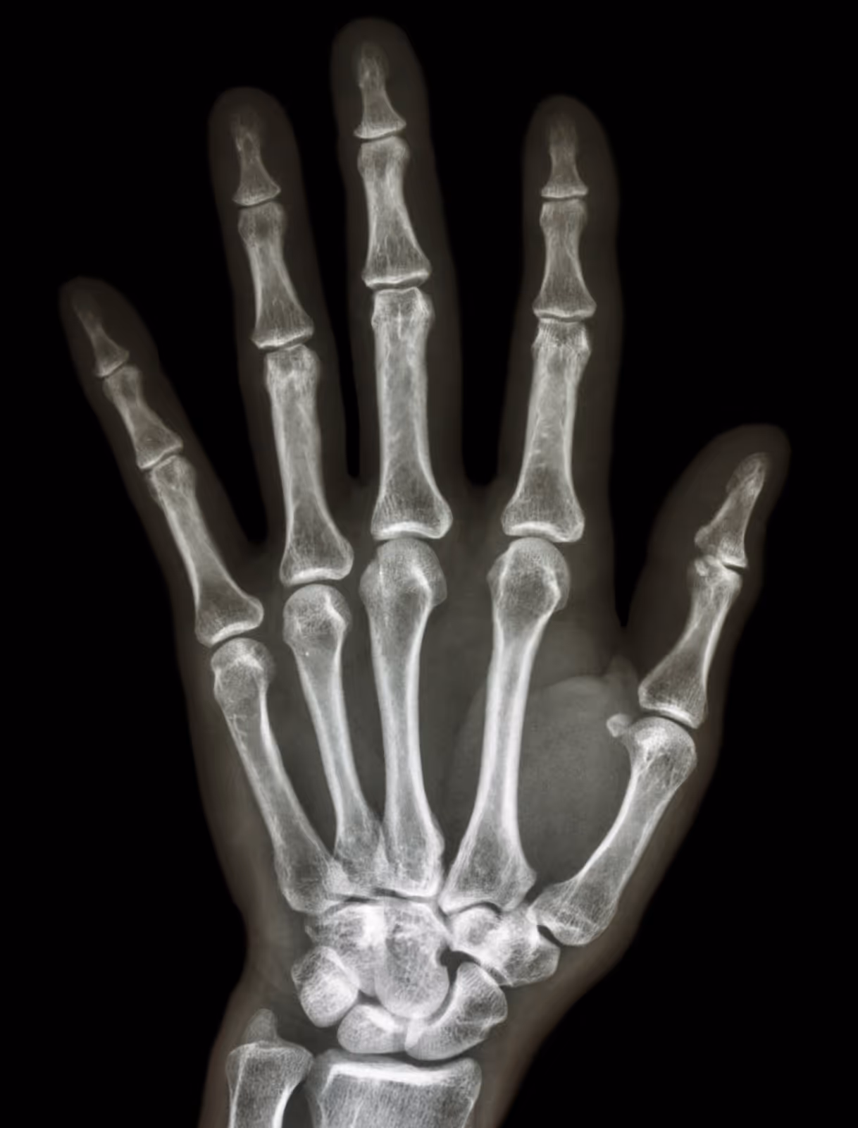 X-ray image showing the bones of a human hand including phalanges, metacarpals, and wrist bones on a black background.