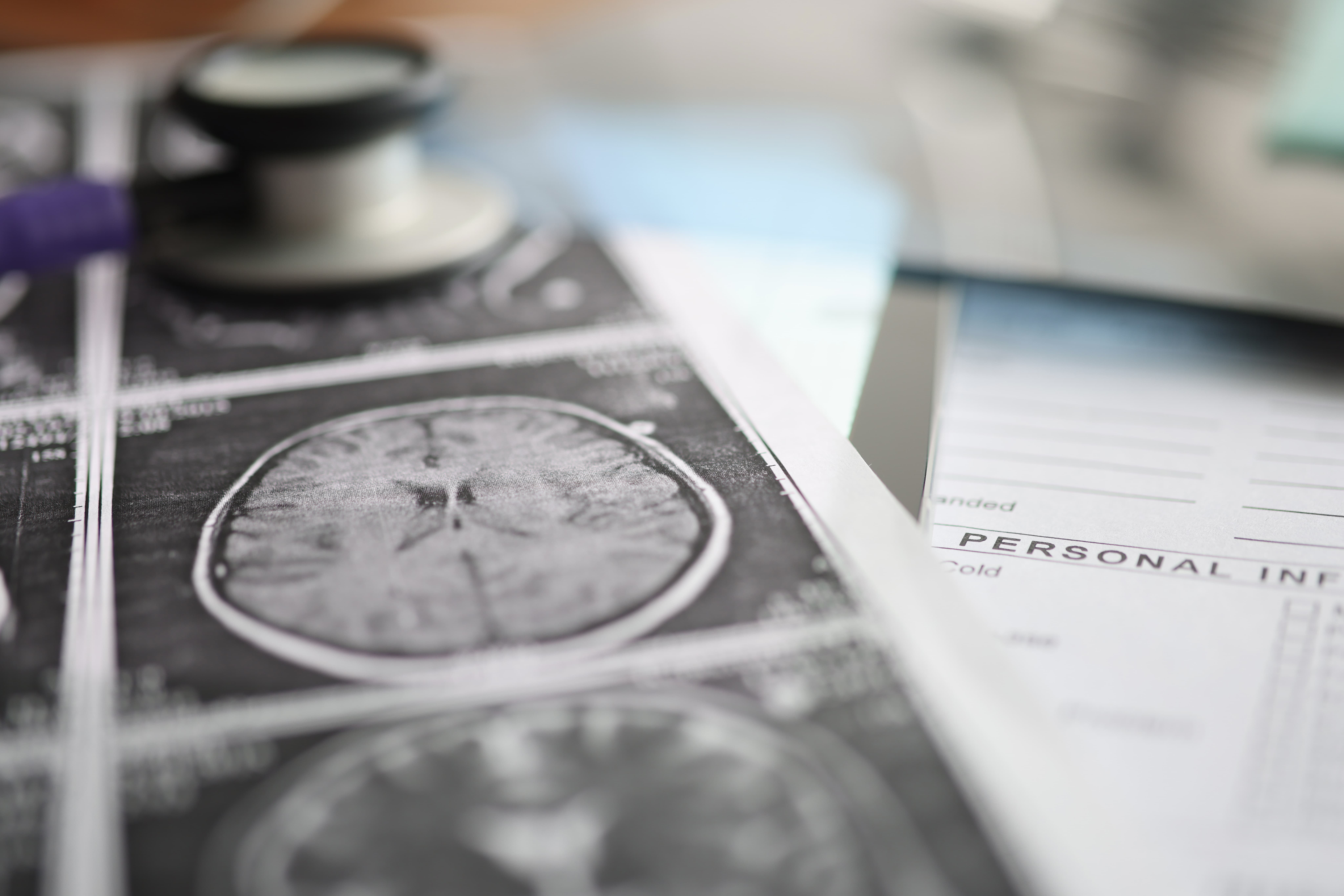 Black and white close-up of brain scan films on a desk beside a stethoscope and a patient information form.