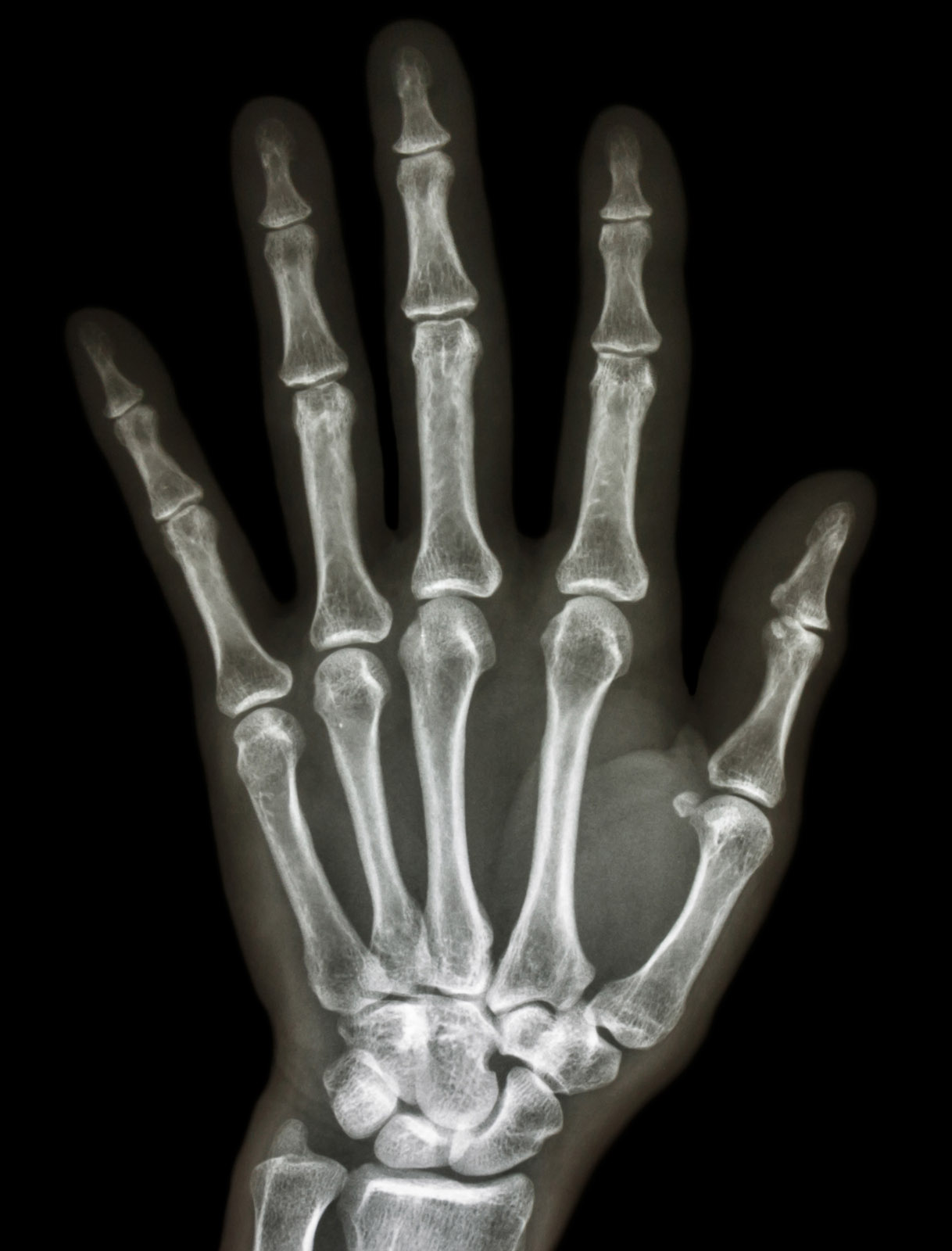 X-ray image showing the bones of a human hand, including the phalanges, metacarpals and wrist bones.
