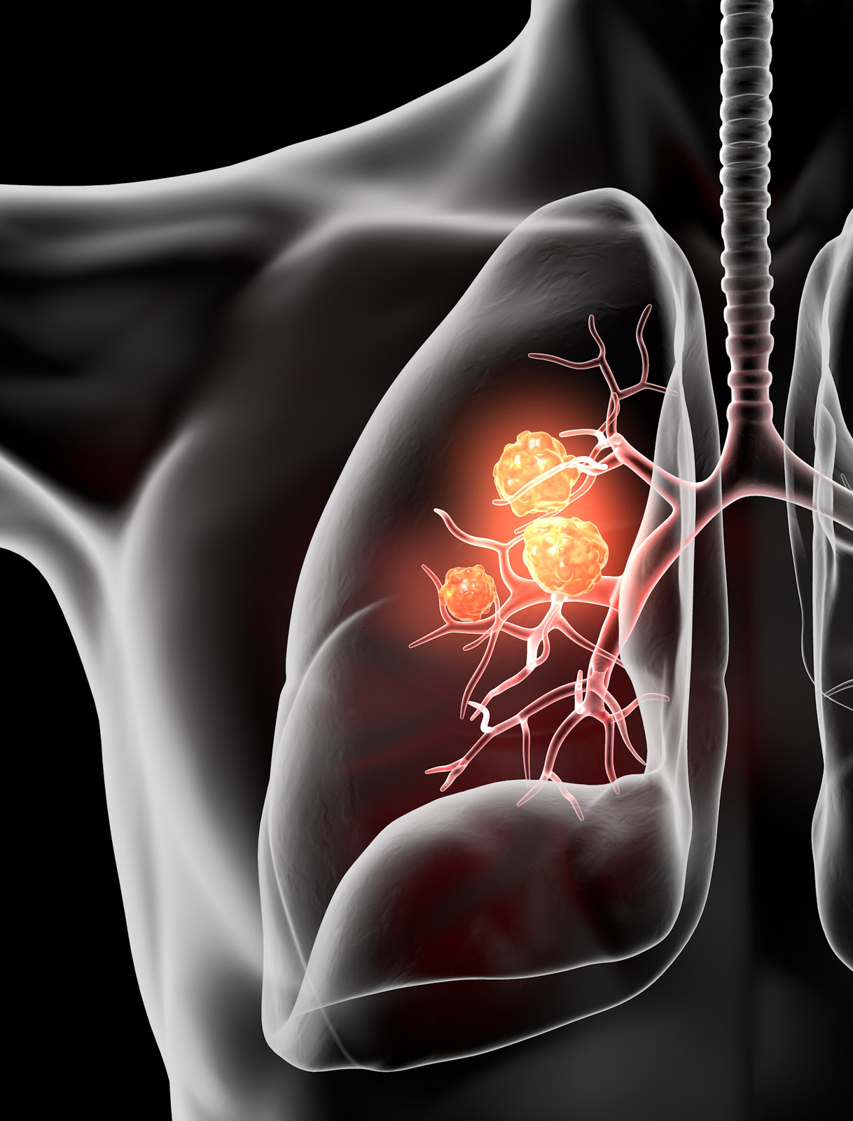 Medical illustration of a lung with highlighted cancerous tumors in the bronchial branches.