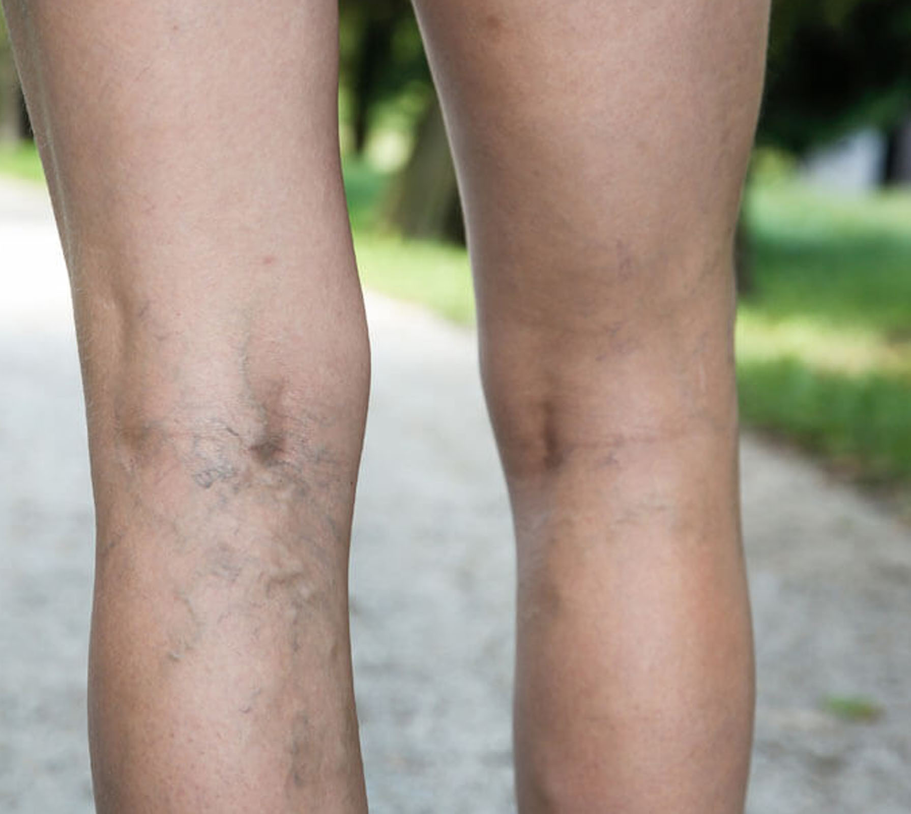 Close-up of the backs of a person's legs showing visible varicose veins.