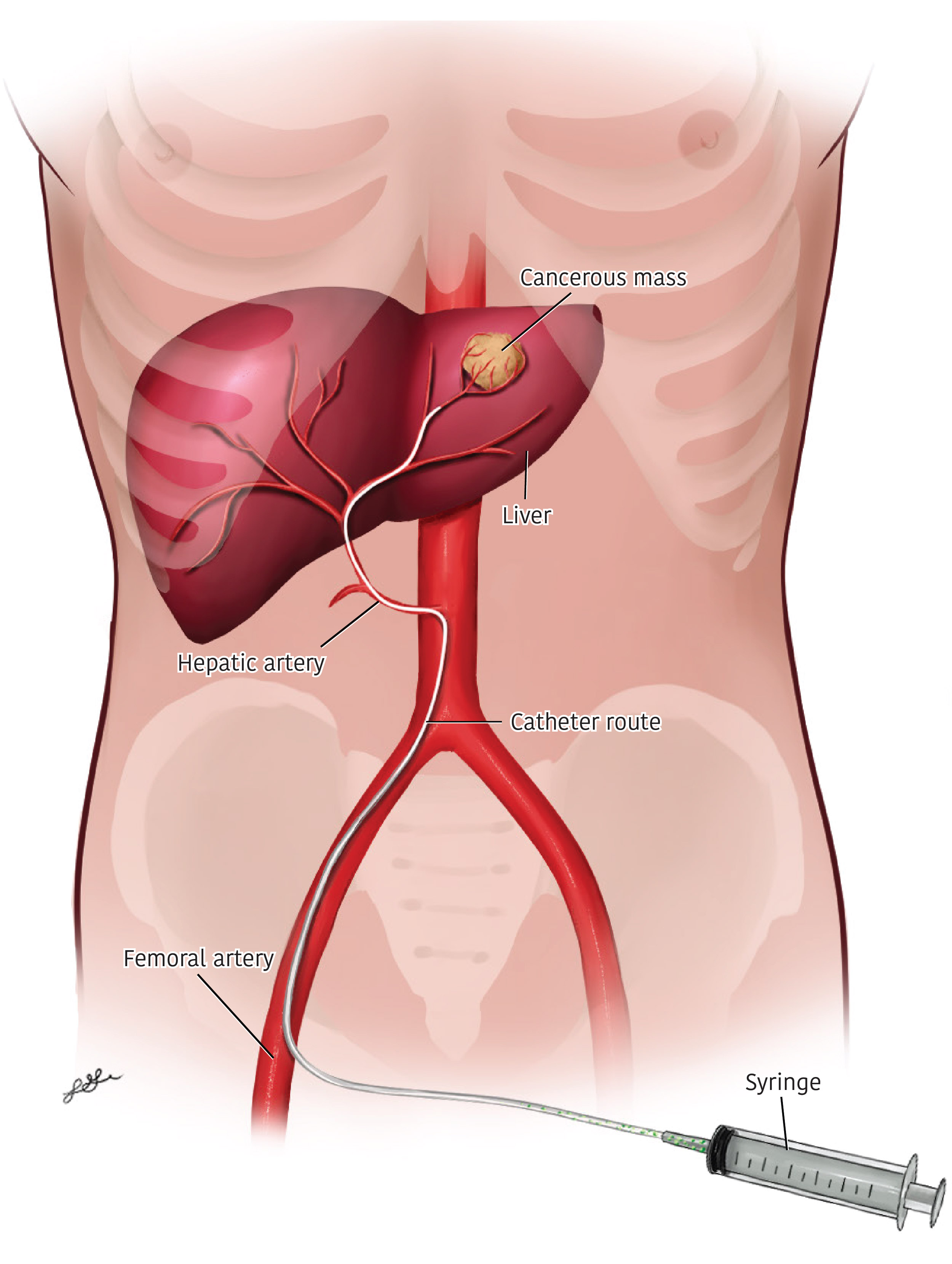 Medical illustration of the liver and abdominal arteries with a catheter delivering treatment to a tumor.