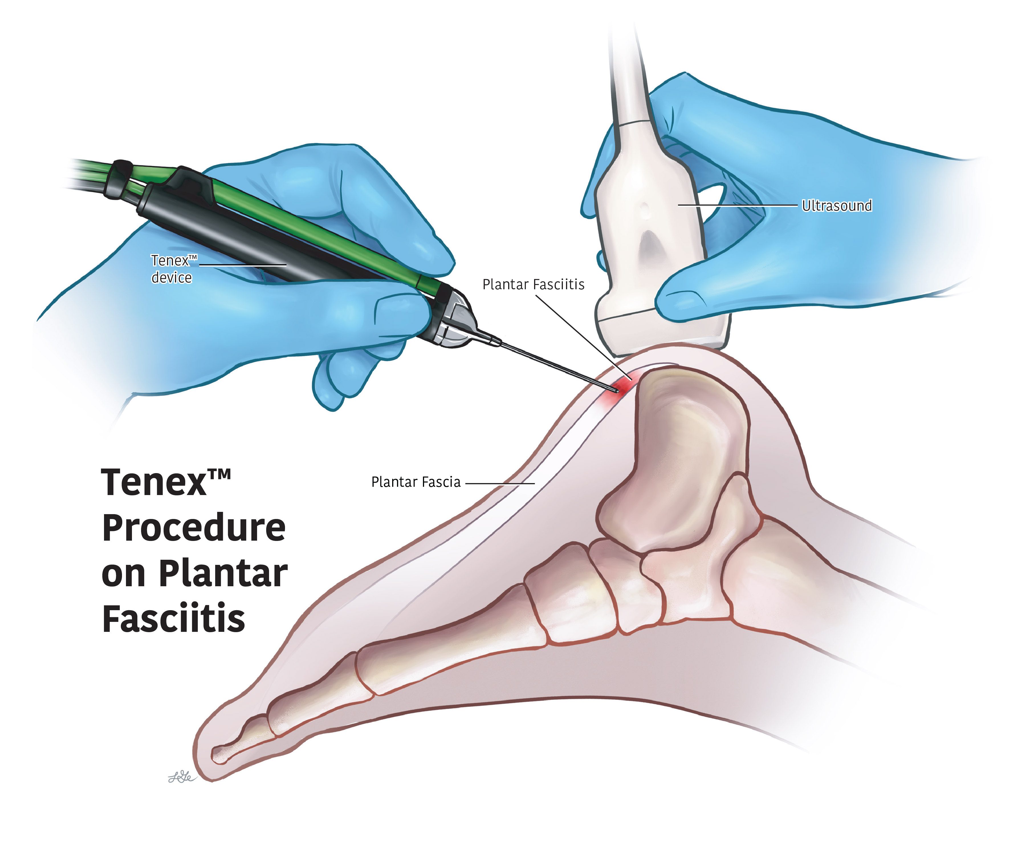 Illustration of the Tenex procedure treating plantar fasciitis in the heel and foot.