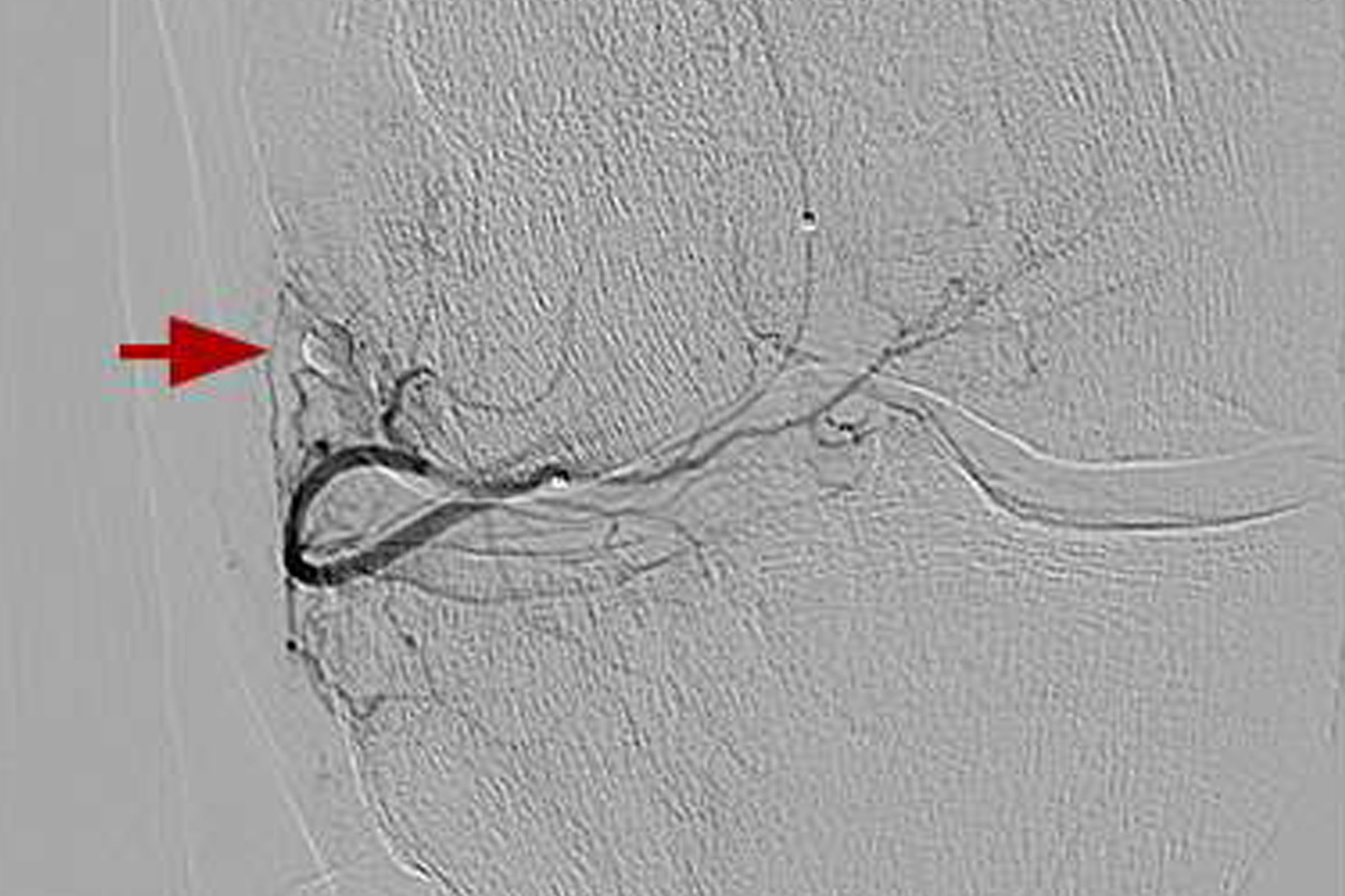 An angiogram image with a red arrow marking a branch of the artery being treated.