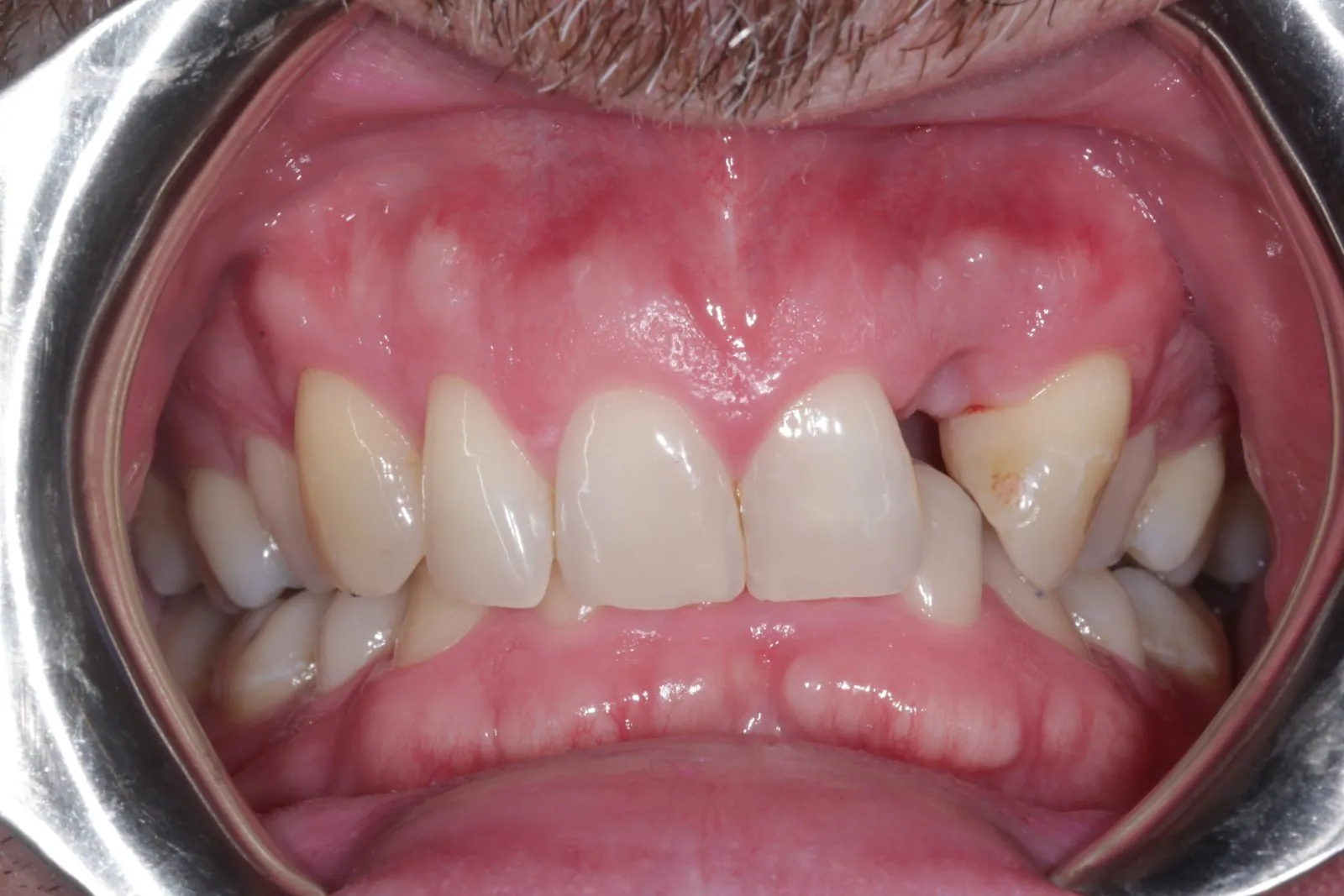 Before: a gap where an upper front tooth is missing, before dental implant treatment at The Limes Dental Practice, Gloucester