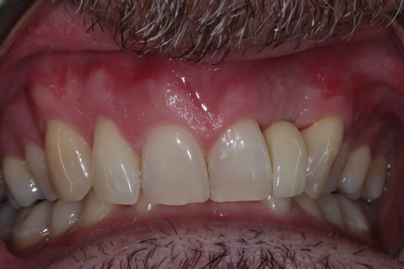 After: the gap replaced with a dental implant crown at The Limes Dental Practice, Gloucester