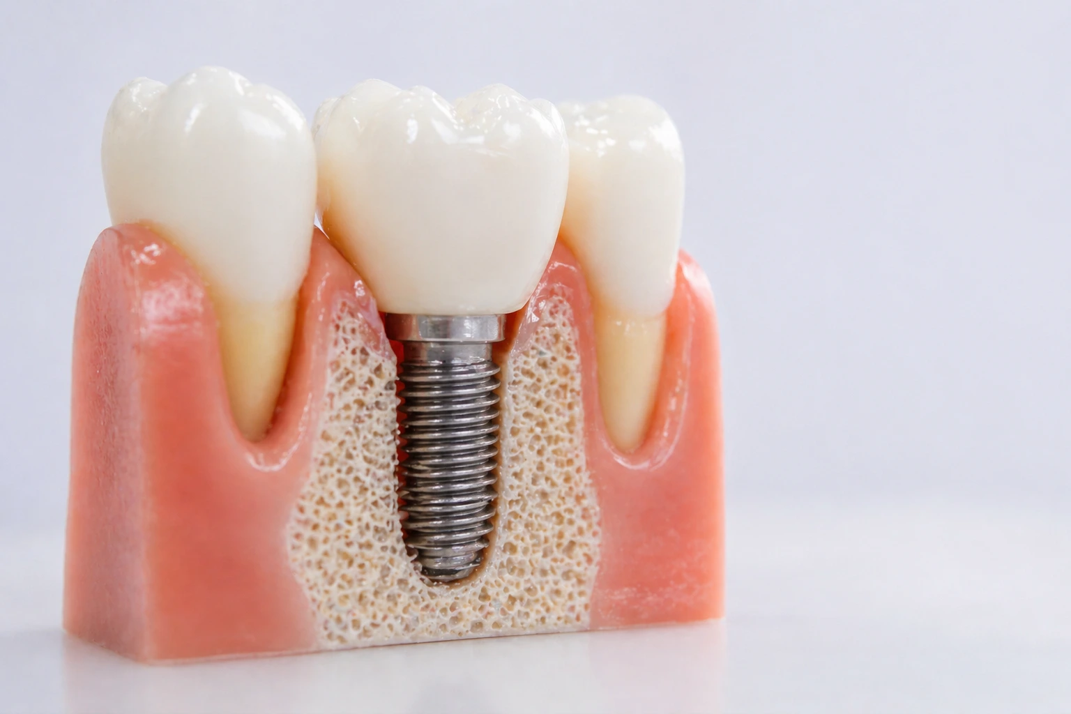 Dental implant showing titanium post and ceramic crown