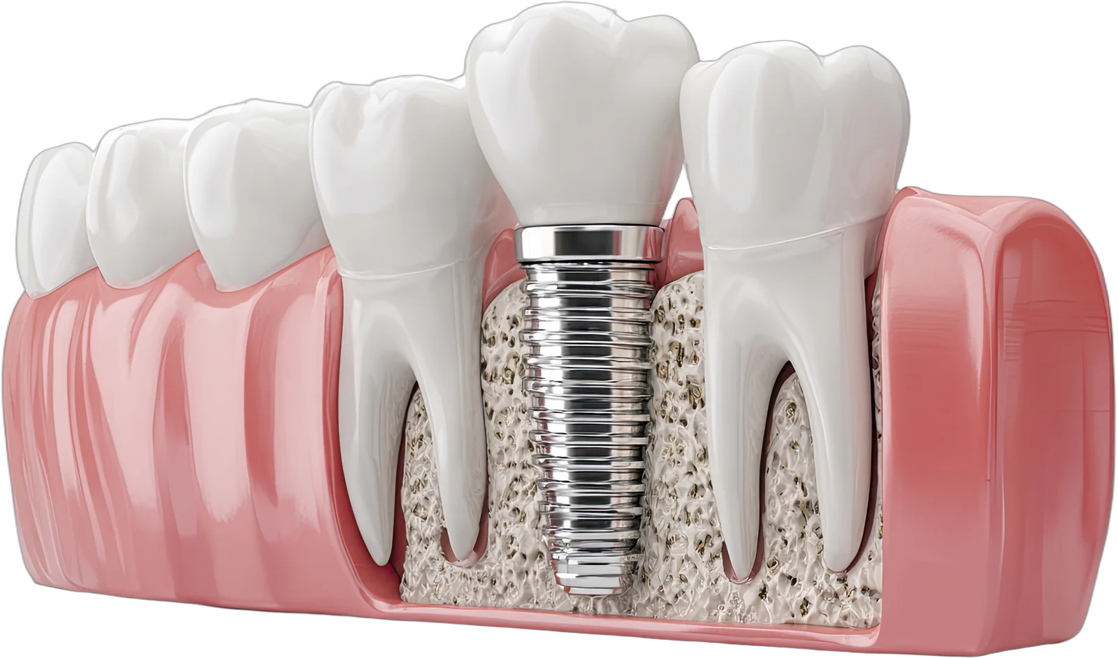 Cross-section diagram of a dental implant titanium post integrated into the jawbone, surrounded by natural teeth