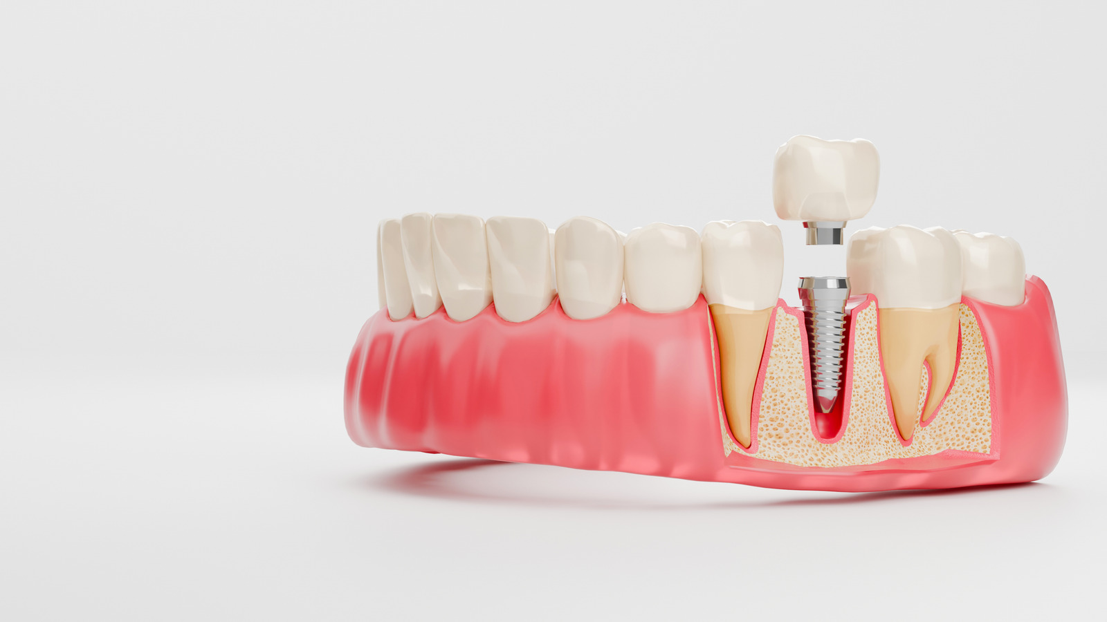 Cross-section diagram showing dental implant post, abutment and crown structure