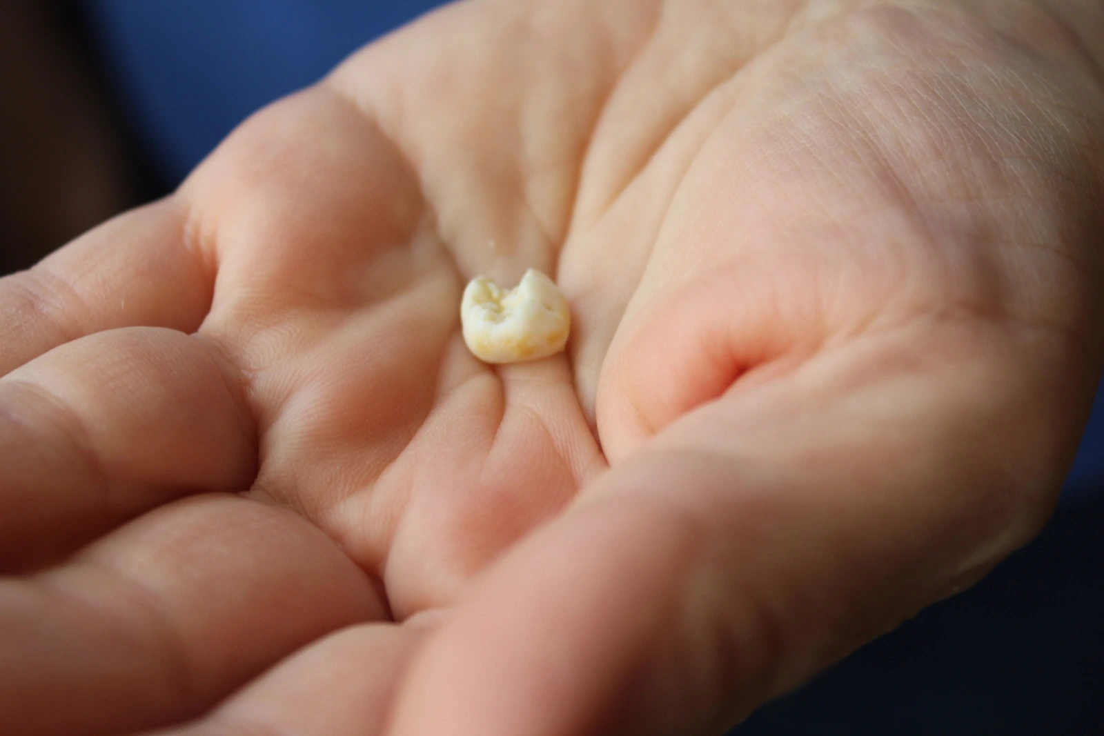 Knocked-out tooth being held carefully in the palm of a hand