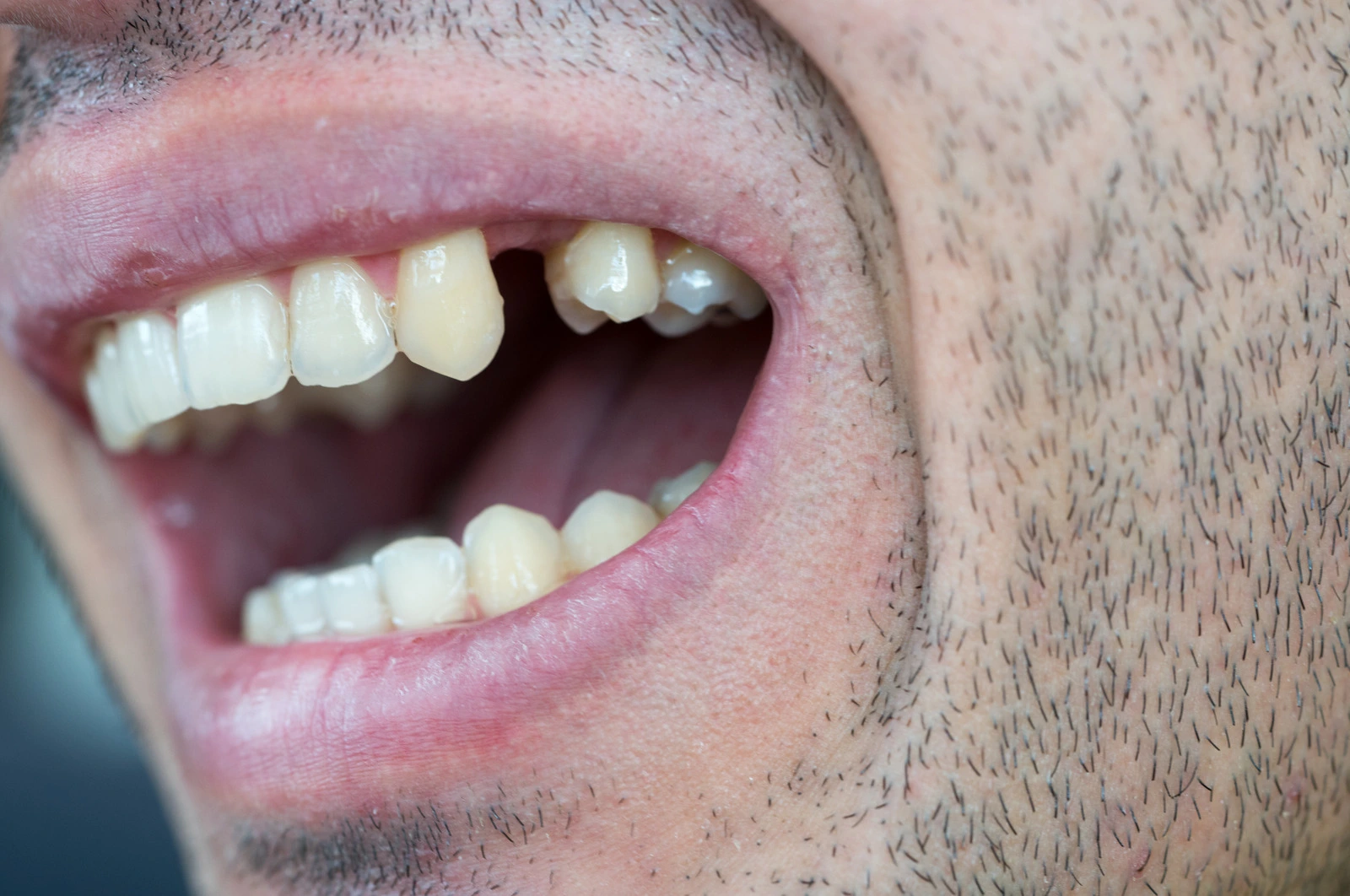 Open mouth showing a gap where a tooth has been knocked out