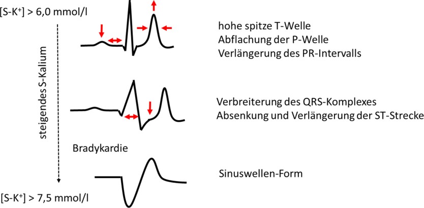 Abb. 3 Mögliche EKG-Veränderungen bei Hyperkaliämie