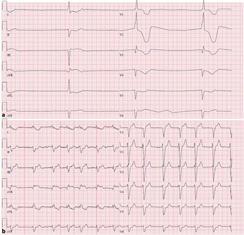 Abb. 6 EKG bei schwerer Hyperkaliämie: vor/nach Therapie mit Kalziumsalzen. Effekt der Verabreichung von 30 ml Calciumgluconat auf das EKG einer Patientin mit schwerer, symptomatischer Hyperkaliämie ([S‑K+] 7,48 mmol/l). EKG: 25 mm/s, 10 mm/mV. a Vor der Gabe: Bradykardie, QRS-Verbreiterung, Absenkung der ST-Strecke, b nach der Gabe von Calciumgluconat: Normalisierung der Herzfrequenz (bei Vorhofflimmern), des QRS-Komplexes und der ST-Streckenveränderung