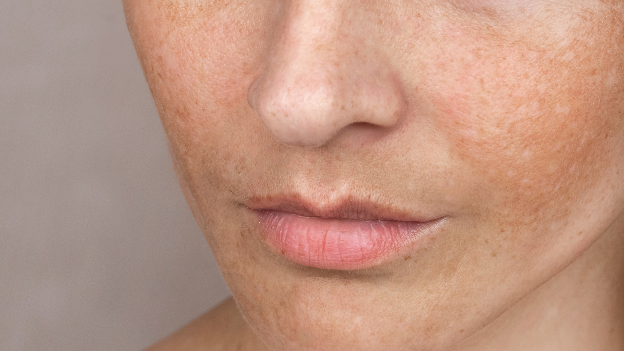 Vrouw met symmetrische bruine pigmentvlekken (melasma) op de wangen, bovenlip en voorhoofd