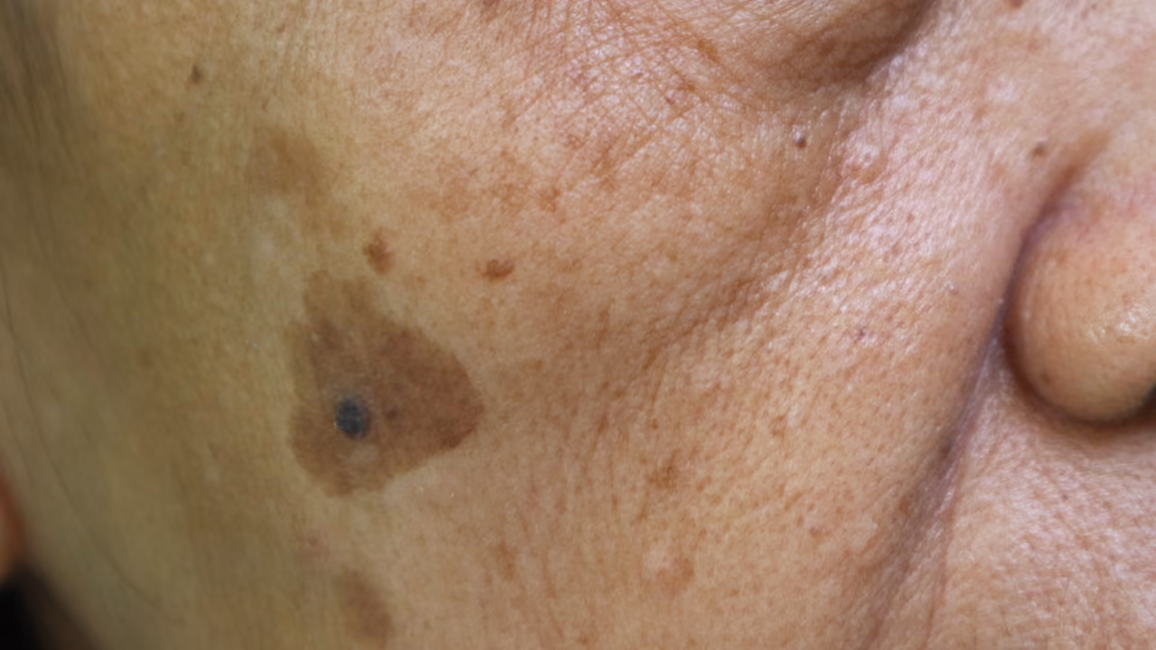 Ouderdomsvlekken (lentigo solaris) op de handruggen van een volwassen persoon